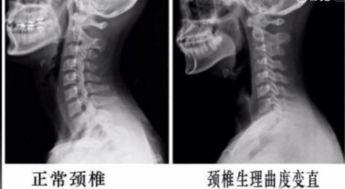 颈椎头手对抗视频,轻松缓解颈肩不适
